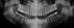 Panoramic dental X-ray of a full set of teeth — Why do Dentists Always Take X-Rays on First Visit?
