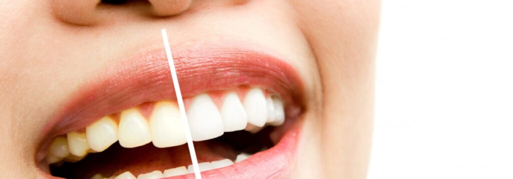 Teeth Cleaning vs. Teeth Whitening