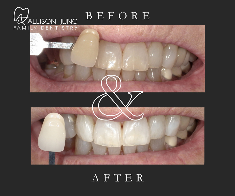 Before and after KöR teeth whitening, showing noticeably whiter teeth